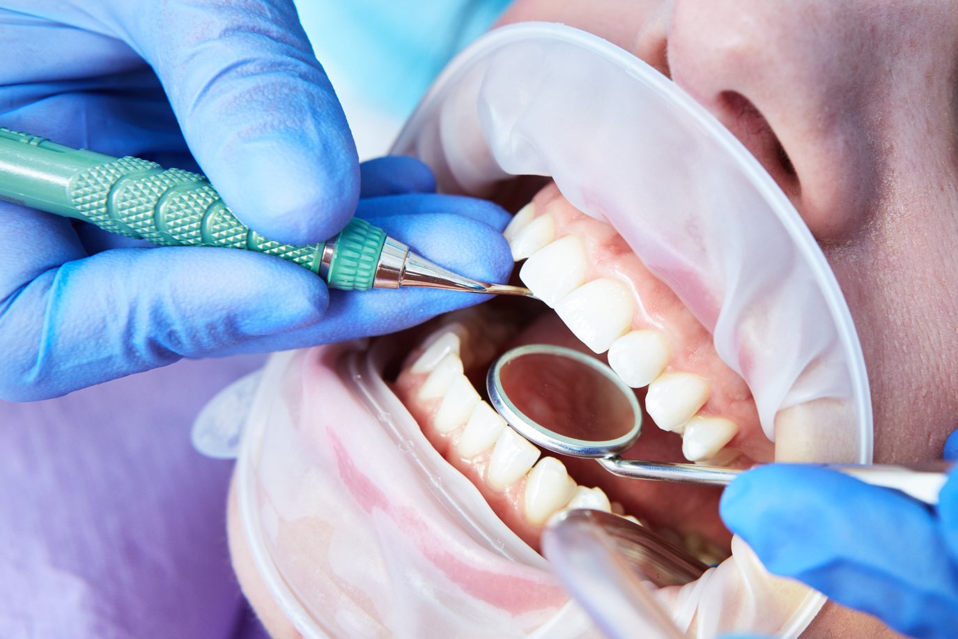  Opening of Mouth Wide during Inspection of Oral Cavity. 